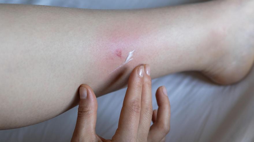 cuales son los mejores remedios caseros para ahuyentar mosquitos