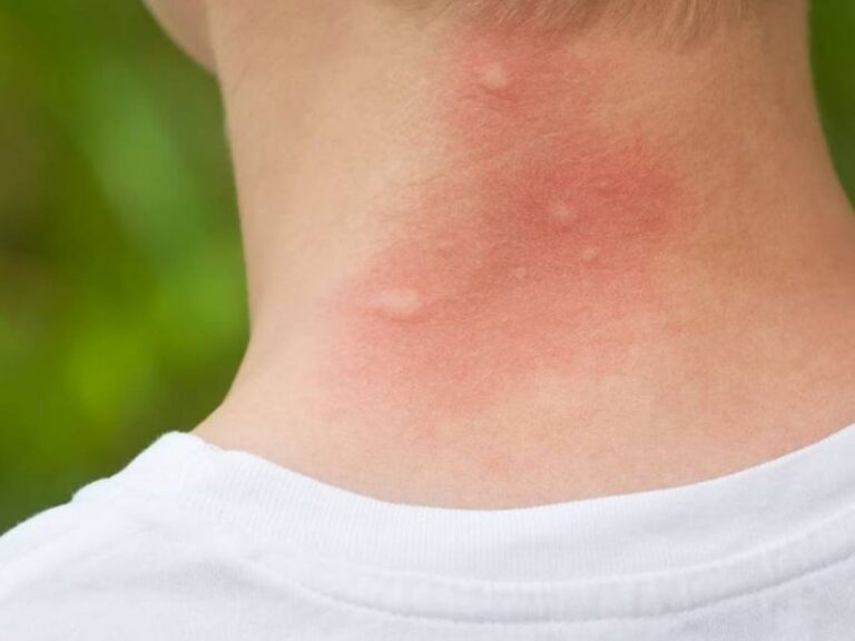 Mosquitoes: Cómo Protegerte de sus Picaduras y Enfermedades
