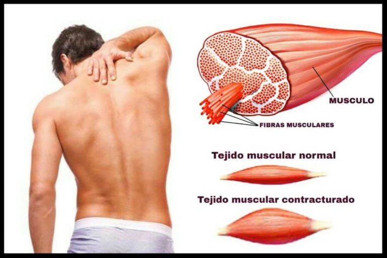 Qué son los puntos gatillo en la espalda y cómo aliviar el dolor